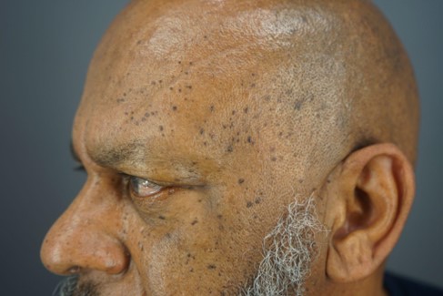 The patient had many skin tags (DPN) spread across his face and forehead.