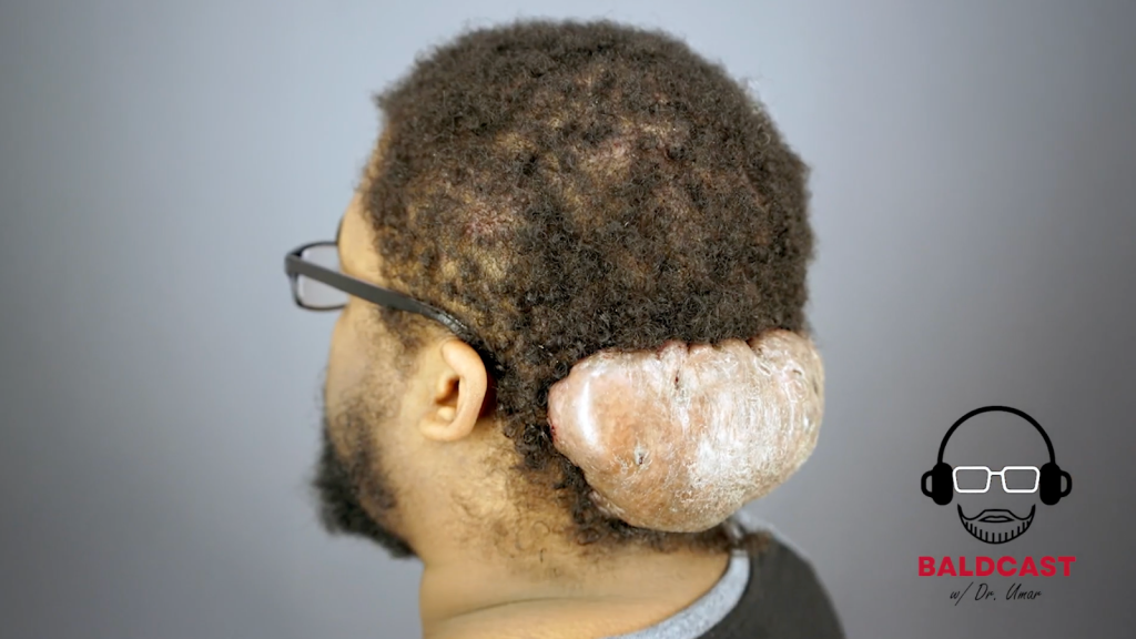 Adrian would hide the large Acne Keloidalis Nuchae (AKN) mass with beanies and hoodies, despite feeling uncomfortable in them.