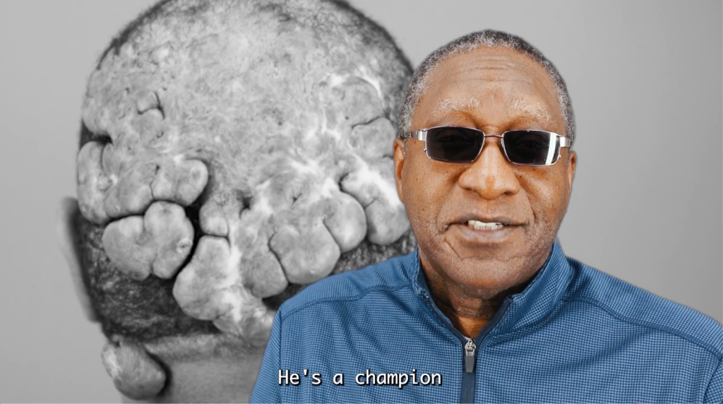 Our patient’s father mentions how he sees his son as a champion because of how well he lives through his life positively with FD and AKN.

