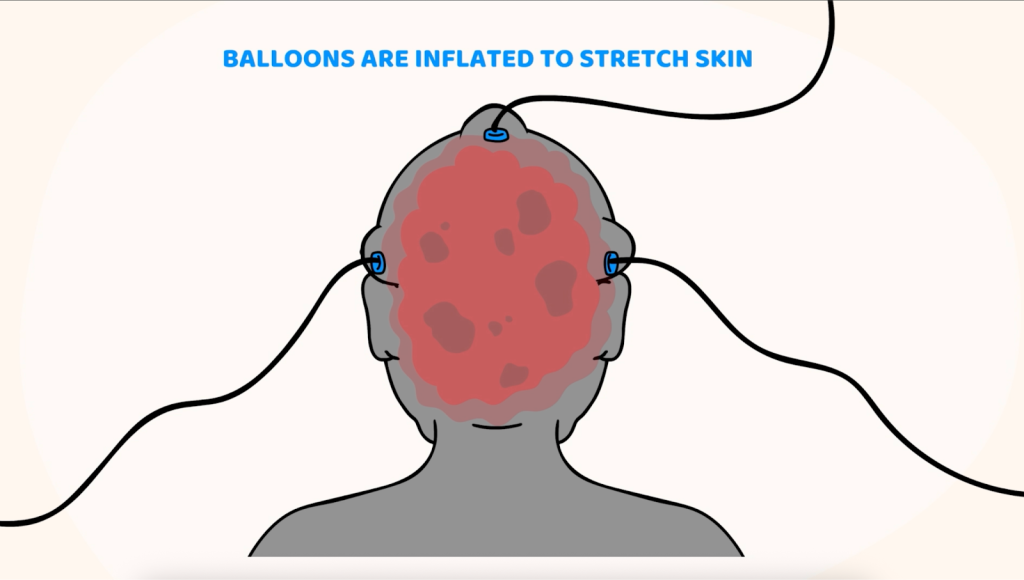 Medical illustration showing how the balloon expansion method stretches surrounding scalp skin, causing significant trauma.