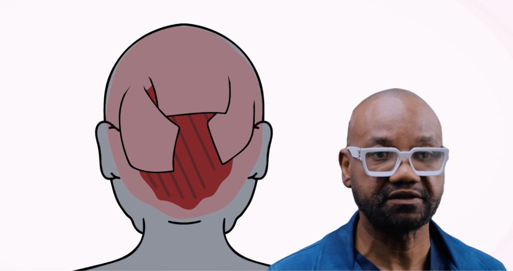 Dr. Umar describes how trauma from balloon expansion can trigger new inflammation in Folliculitis Decalvans patients.