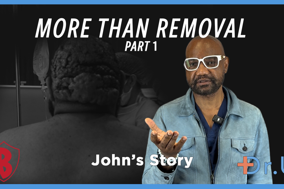 More Than the Removal of Posterior Scalp Scarring Disorder (Part 1)