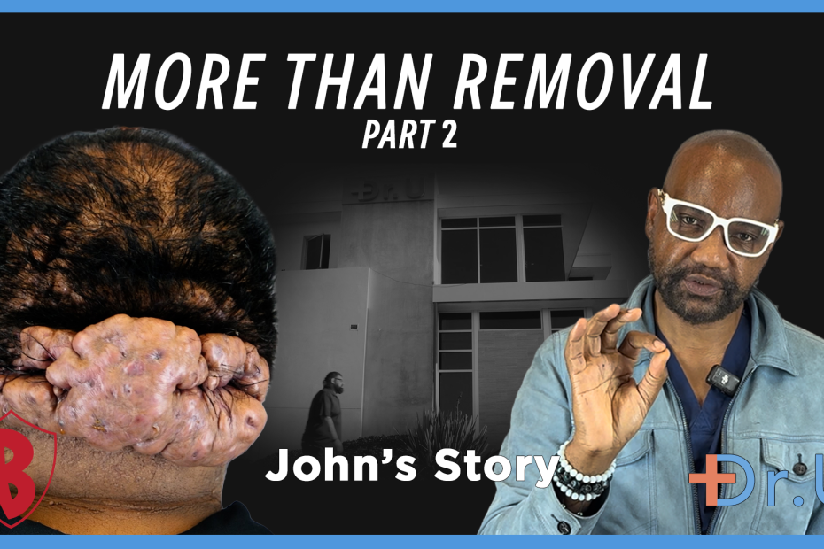 More Than the Removal of Posterior Scalp Scarring Disorder (Part 2)