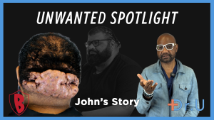 unwanted spotlight due to inflamed scalp cysts