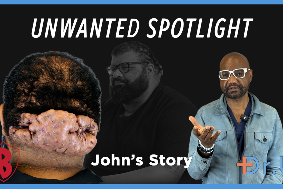 unwanted spotlight due to inflamed scalp cysts