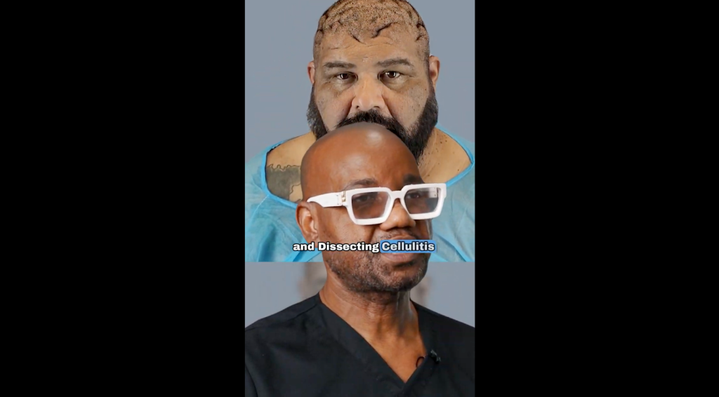 Dr. Sanusi Umar explains the intertwined condition of John’s complex scalp condition.