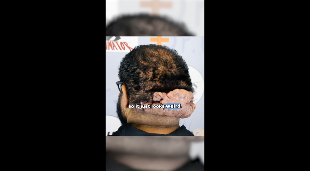 John Picone’s bumps on the back of the head caused by chronic scalp inflammation.