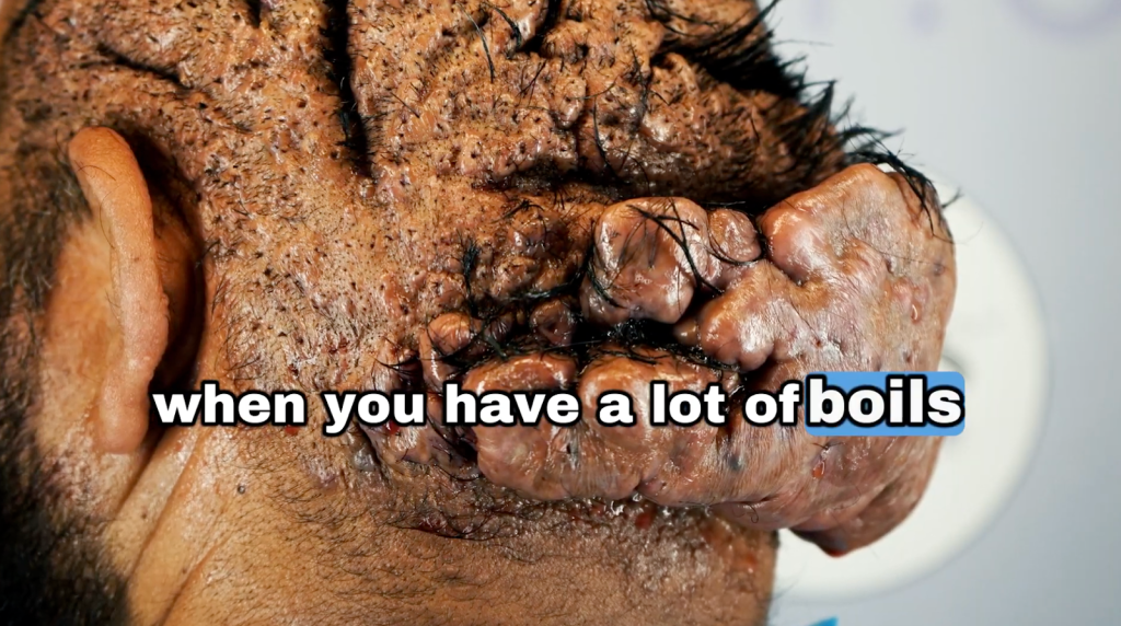 A close-up look on John’s back of the head with deep cysts and boils on the scalp.
