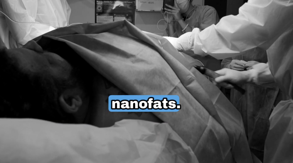 Dr. Sanusi Umar extracts fat from John’s abdomen to create nanofat used for regenerative scalp healing.