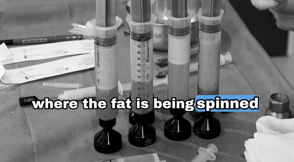 Processed nanofat being prepared after spinning and filtering fat cells for regenerative scalp treatment.