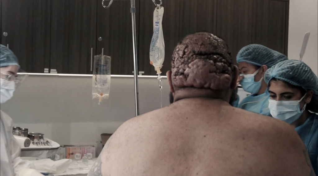 Patient preparing for posterior scalp scarring disorder surgery while the surgical team organizes instruments and equipment.