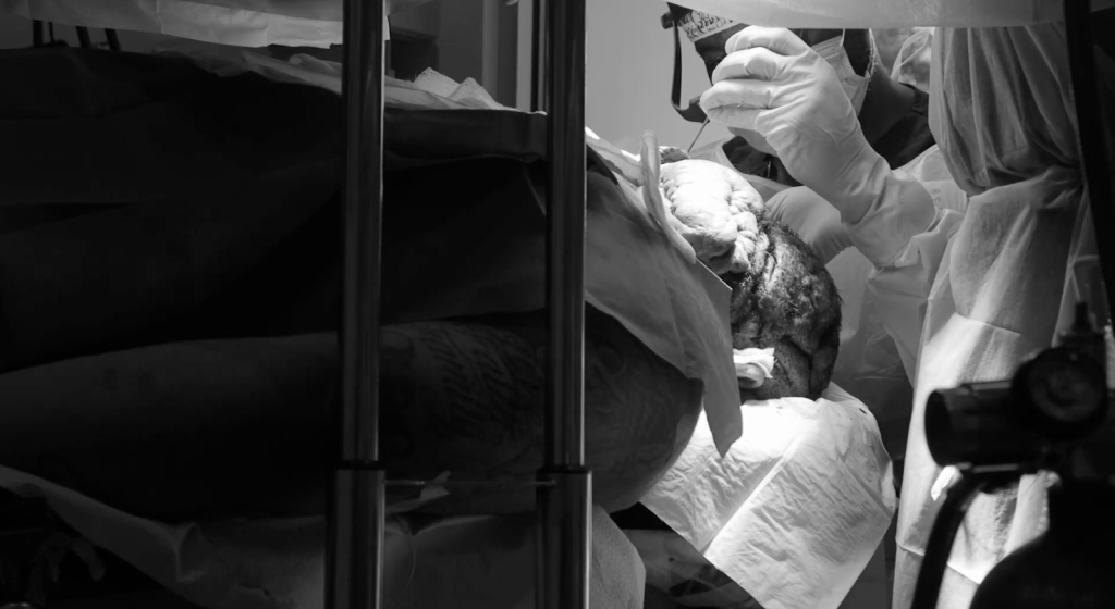 John undergoing posterior scalp scarring disorder surgery as Dr. Sanusi Umar removes chronic scalp lesions.