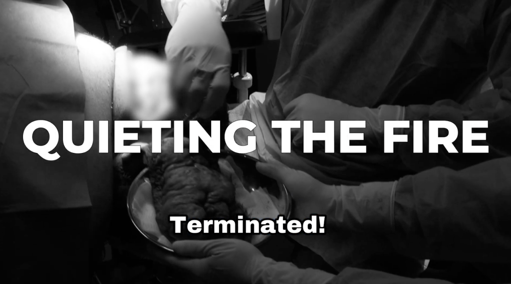 Dr. Sanusi Umar completes the removal of a diseased scalp bump during treatment for pus bumps on the scalp.