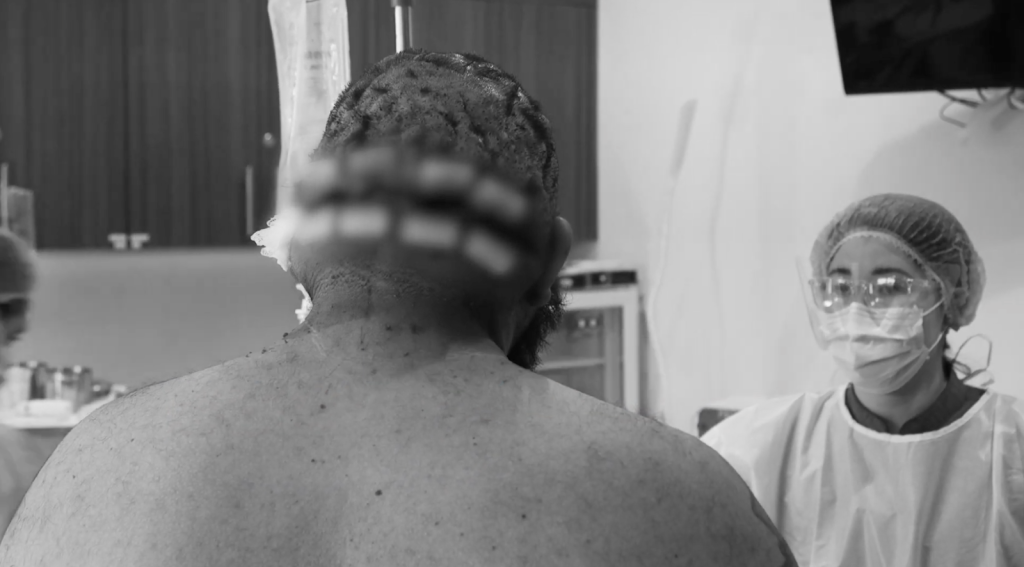 The back of John’s scalp after surgery removing chronic inflammatory scalp lesions.