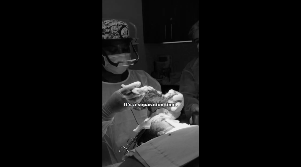 Dr. Sanusi Umar has successfully removed the diseased portion of Anwar’s scalp using a non-traditional approach.