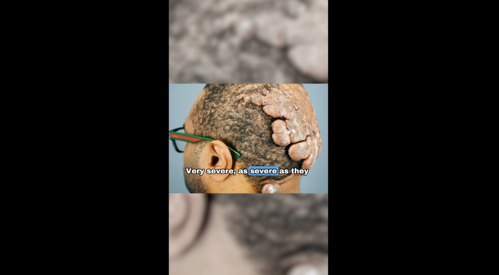 A close-up look on Anwar’s developing painful scalp spots, which has been growing for over 16 years.