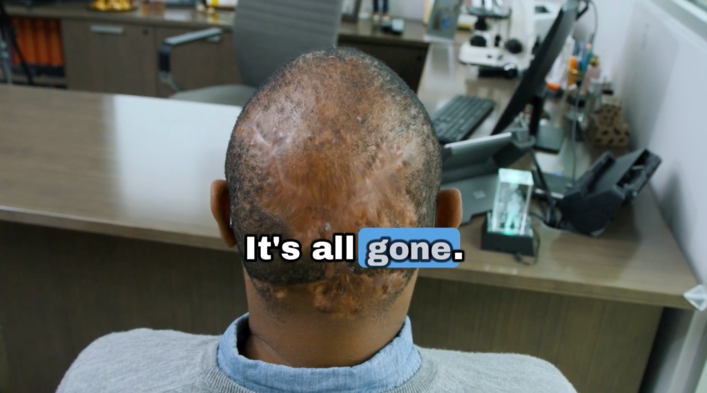 Anwar revealing his healed scalp after AKN treatment as Dr. Sanusi Umar confirms the condition is resolved.