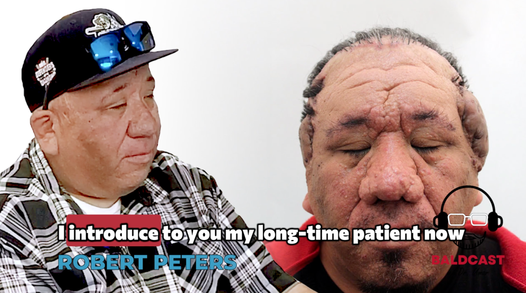 Dr. Sanusi Umar introduces longtime patient Robert Peeters while discussing his acne keloidalis nuchae treatment journey.