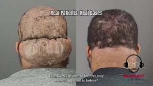 Comfort Returns, A Cicatricial Folliculitis Story | Adrian’s Journey