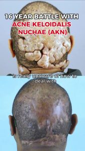 16 year battle with acne keloidalis nuchae