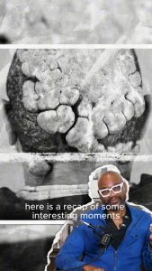 From Hidden Pain to Hope Anwar’s Journey with Scalp Bumps