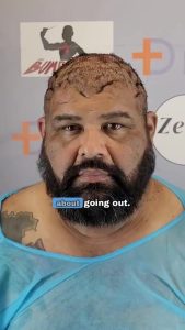 How Giant Scalp Keloids Pushed John To The Edge