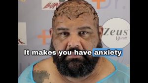 How Giant Scalp Keloids Pushed John To The Edge | A Redemption Story