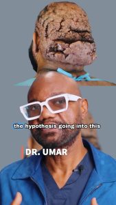When Acne Keloidalis Nuchae Meets Dissecting Cellulitis | Part 2