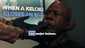 Ear Keloid Deforming the Ear: Festus’ First Exam (Festus Chapter 2)