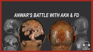 Anwar’s Severe AKN & Folliculitis Decalvans Journey | Full Baldcast Episode