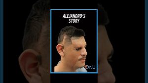 How Body Hair Helped Restore Alex’s Eyebrow and Beard