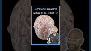 PIILIF in Dissecting Cellulitis: The Inflammation You May Not See