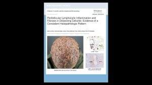 Can Dissecting Cellulitis Extend Beyond Visible Lesions?
