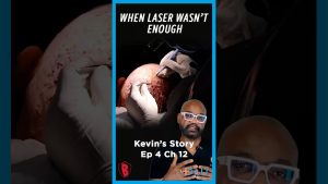 When Laser Treatment Wasn’t Enough for Dissecting Cellulitis