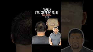 AKN Testimonial: Raul 3 Months After Surgery