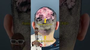Dennis’s Journey With Folliculitis Decalvans & Acne Keloidalis Nuchae