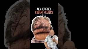 Robert Peeters: 5 Years After Surgery | Before & After