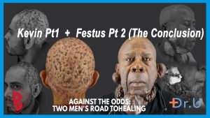 When Treatments Fail: Dissecting Cellulitis and a New Keloid Treatment Approach
