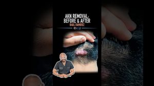 AKN Before and After at 3 Months | Raul Ramirez