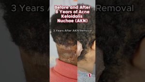 AKN Removed After Years of Painful Scalp Bumps