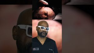 Kevin’s Scalp Improved After 3 Months on a Personalized Treatment Plan