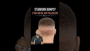 Persistent Hair Transplant Bumps? It May Not Be Just Infection