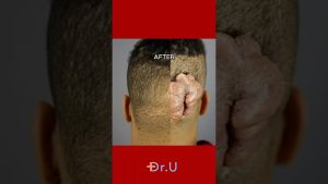 Keloid Scar Before and After | Robert's Transformation
