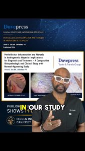 Severe Hair Loss isn’t Always Just Advanced AGA | PIILIF Explained #PIILIF #hairloss #AGA