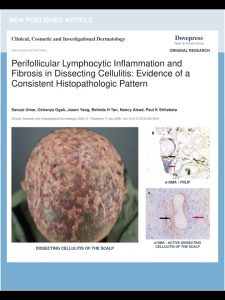 Can Dissecting Cellulitis Extend Beyond Visible Lesions?