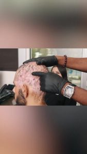 Ep 4 Ch 8 Pt 2: What Treatments Are Available for Frontal Fibrosing Alopecia (FFA)?