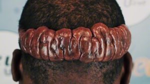 Severe Keloid Removal: Why Surgeons Refuse Treatment