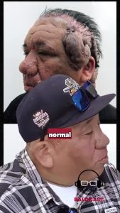 How Folliculitis Tried To Defeat Him. The Fight Robert Won | Dr Umar