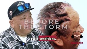 Robert’s Emotional Battle Living With Scalp Keloids | Before the Storm Part 2