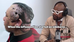 How a Scalp Disease Turned Glasses Into Pain and Sleep Into a Calculation